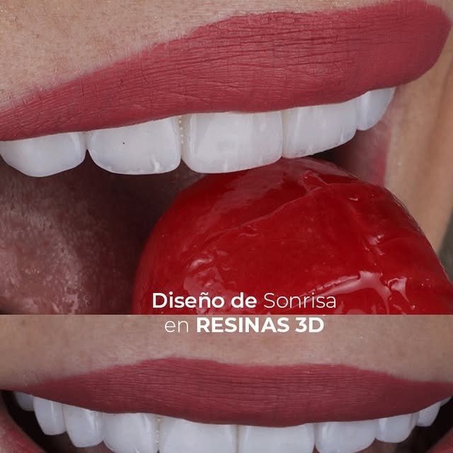 Caso de diseño de sonrisa en resinas 3D