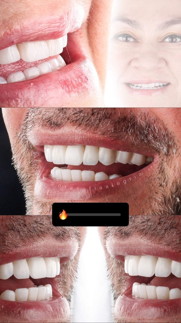 Antes y después de diseño de sonrisa