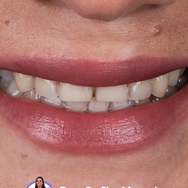 Sonrisa de paciente tratado en la clínica