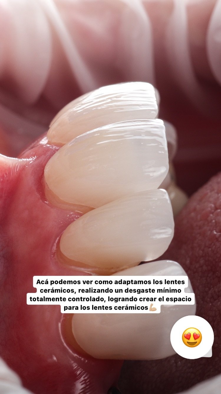 Adaptación de lentes cerámicos en boca