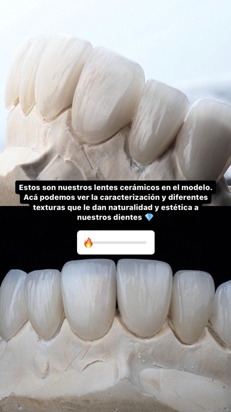 Lentes cerámicos sobre modelo